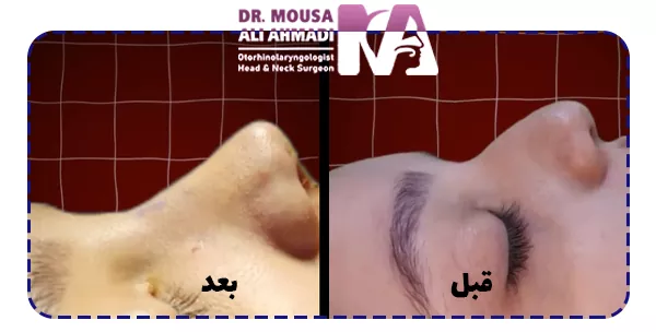 نمونه عکس جراحی بینی قبل و بعد