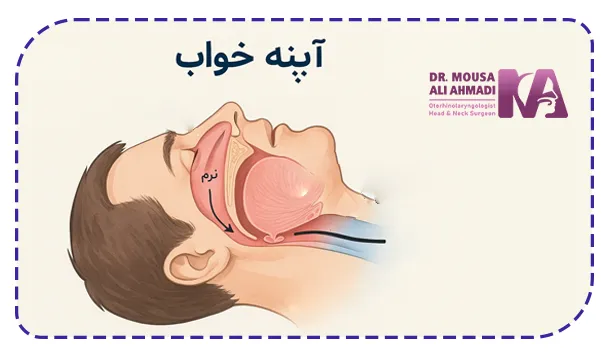 آپنه خواب چیست