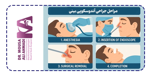 مراحل جراحی آندوسکوپی بینی